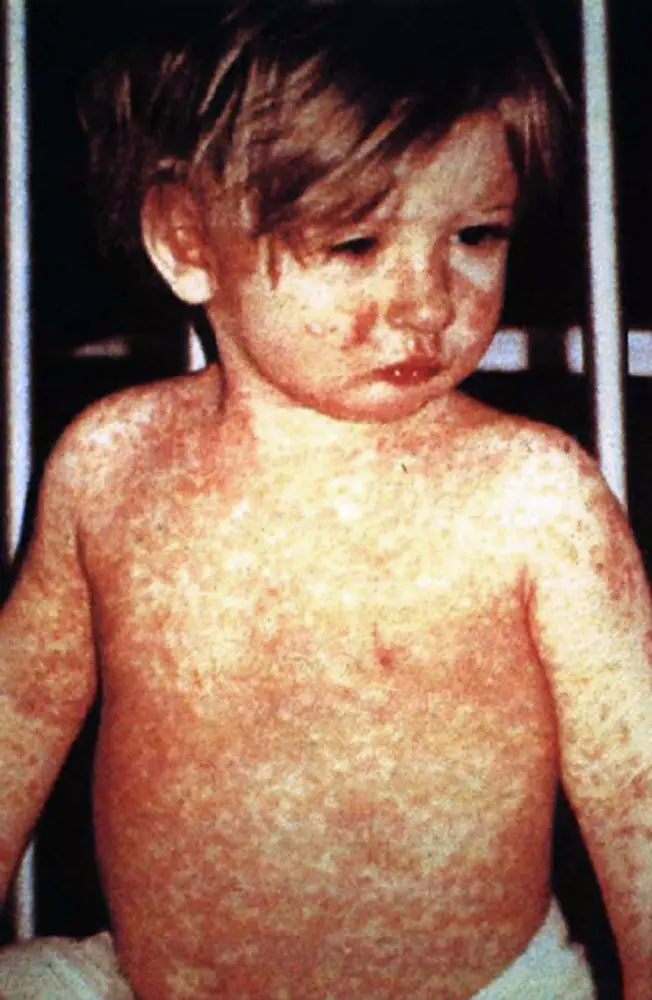 measles-207.jpeg