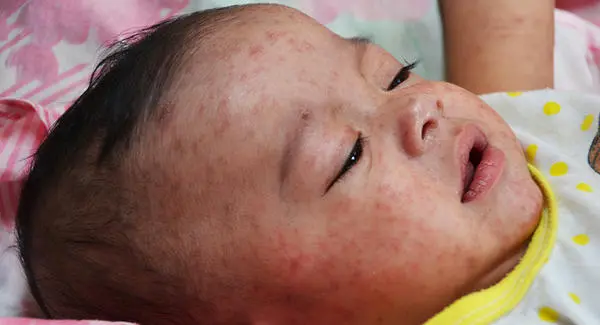 Understanding Measles and the Importance of Vaccination image 1