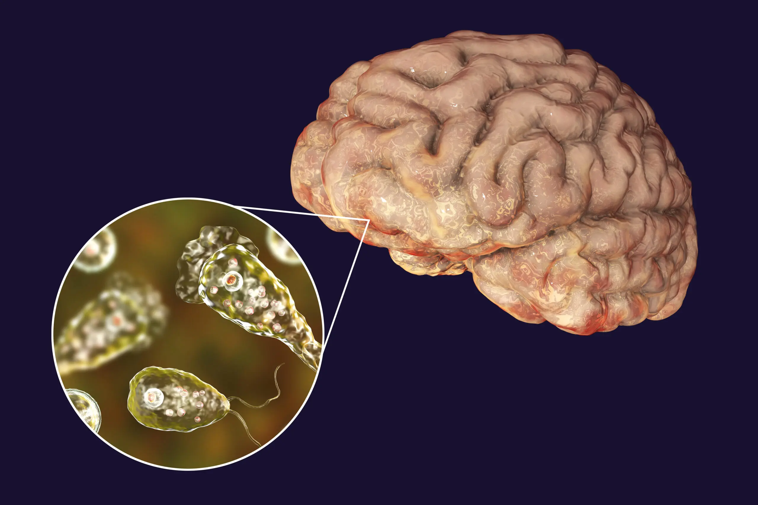 Understanding the Risks of Brain Eating Amoeba in Canada image 1