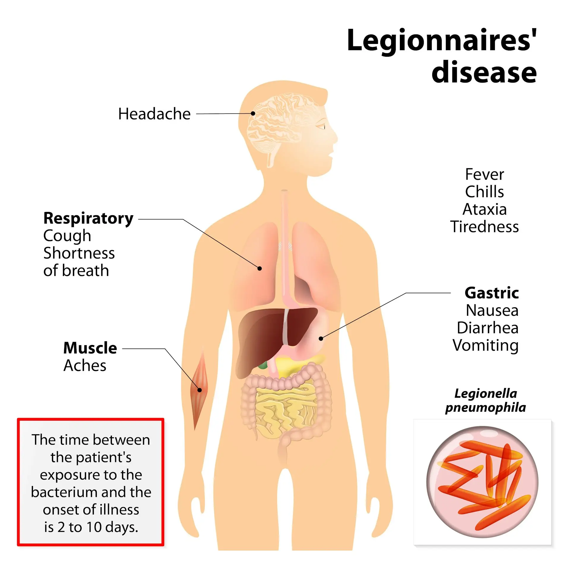 La maladie du légionnaire : Risques et Préventions