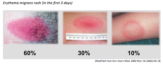 lyme-disease-136.png