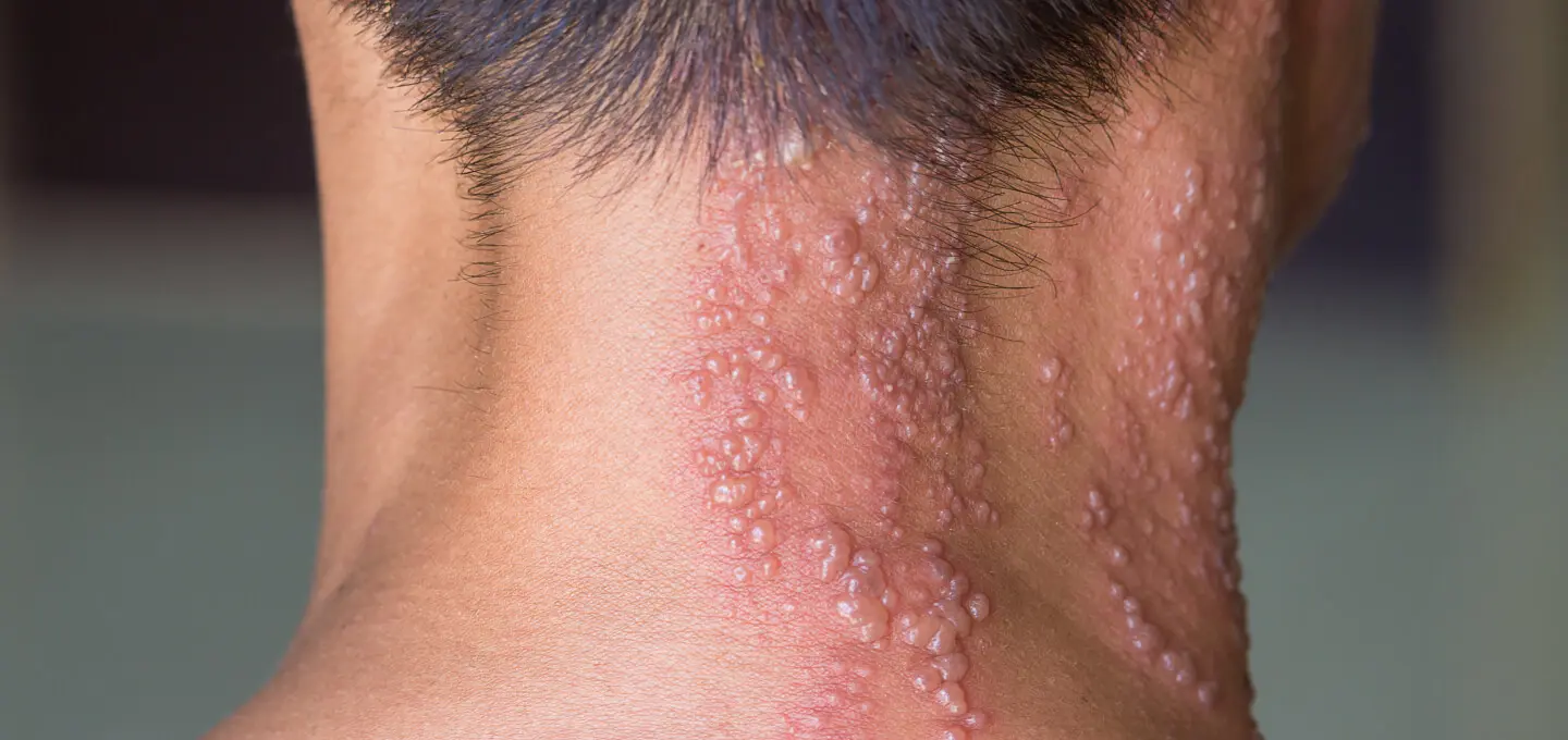 Everything You Need to Know About Shingles: Causes, Symptoms and Prevention