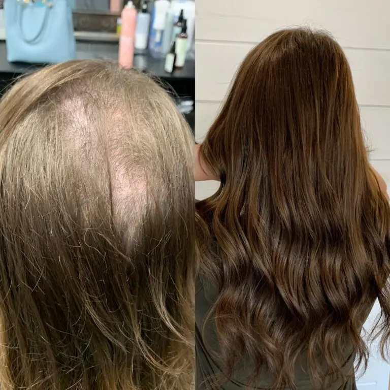 Understanding Trichotillomania: Causes, Symptoms, and Treatments