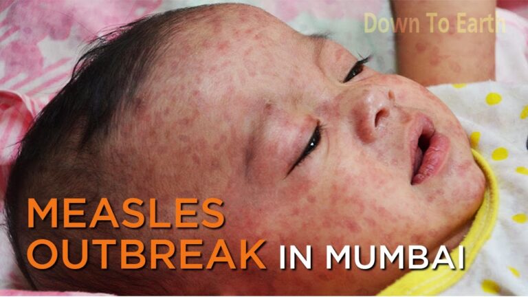 measles-164.jpeg