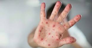measles-ottawa-117.jpeg