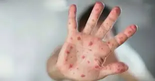 measles-ottawa-117.jpeg