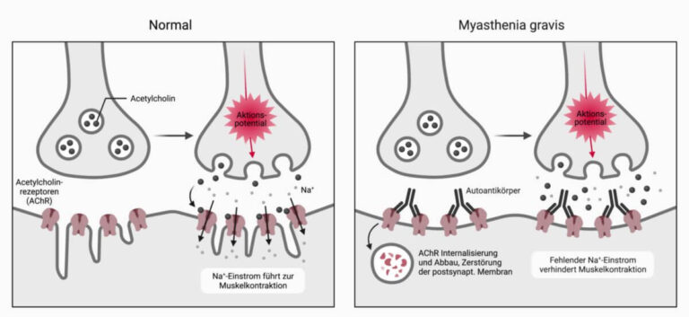 myasthenia-gravis-15.jpeg