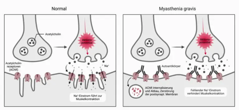 myasthenia-gravis-15.jpeg