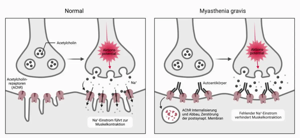 What You Need to Know About Myasthenia Gravis image 1