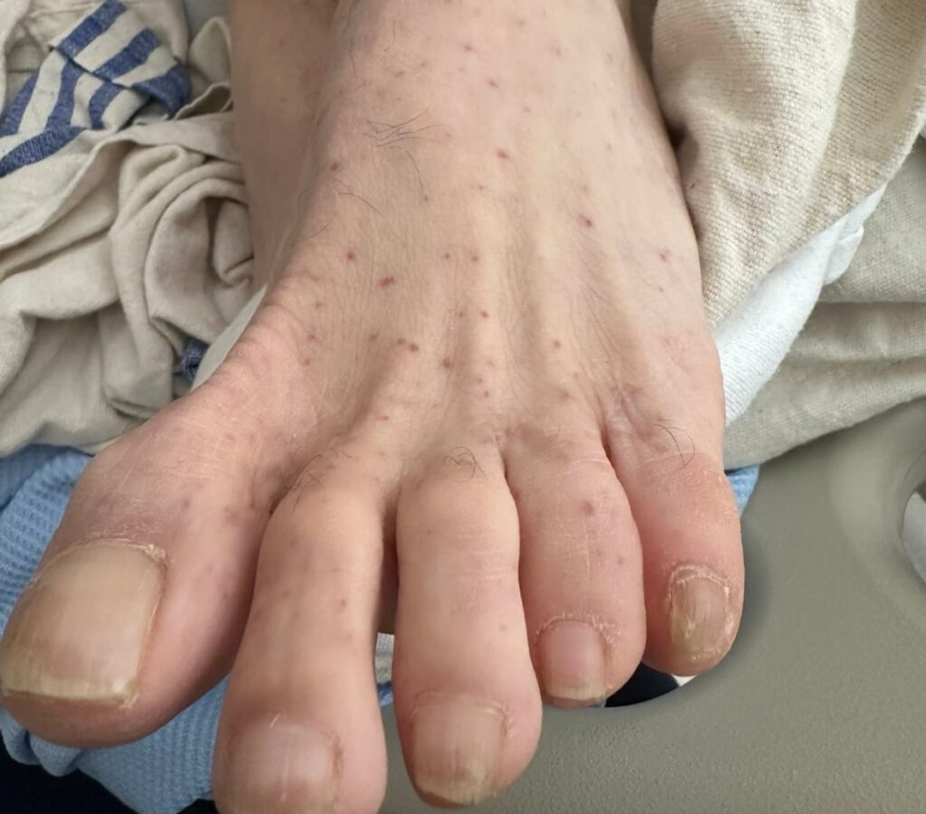rocky-mountain-spotted-fever-53.jpeg