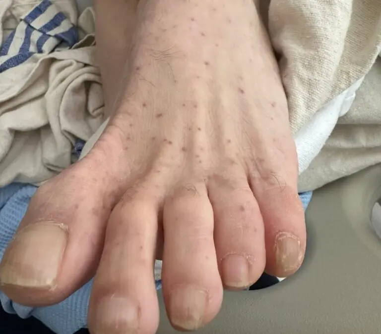 rocky-mountain-spotted-fever-53.jpeg