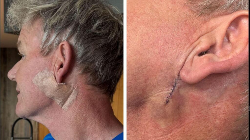 gordon-ramsay-cancer-de-la-peau-67.jpeg