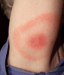 lyme-disease-26.jpeg