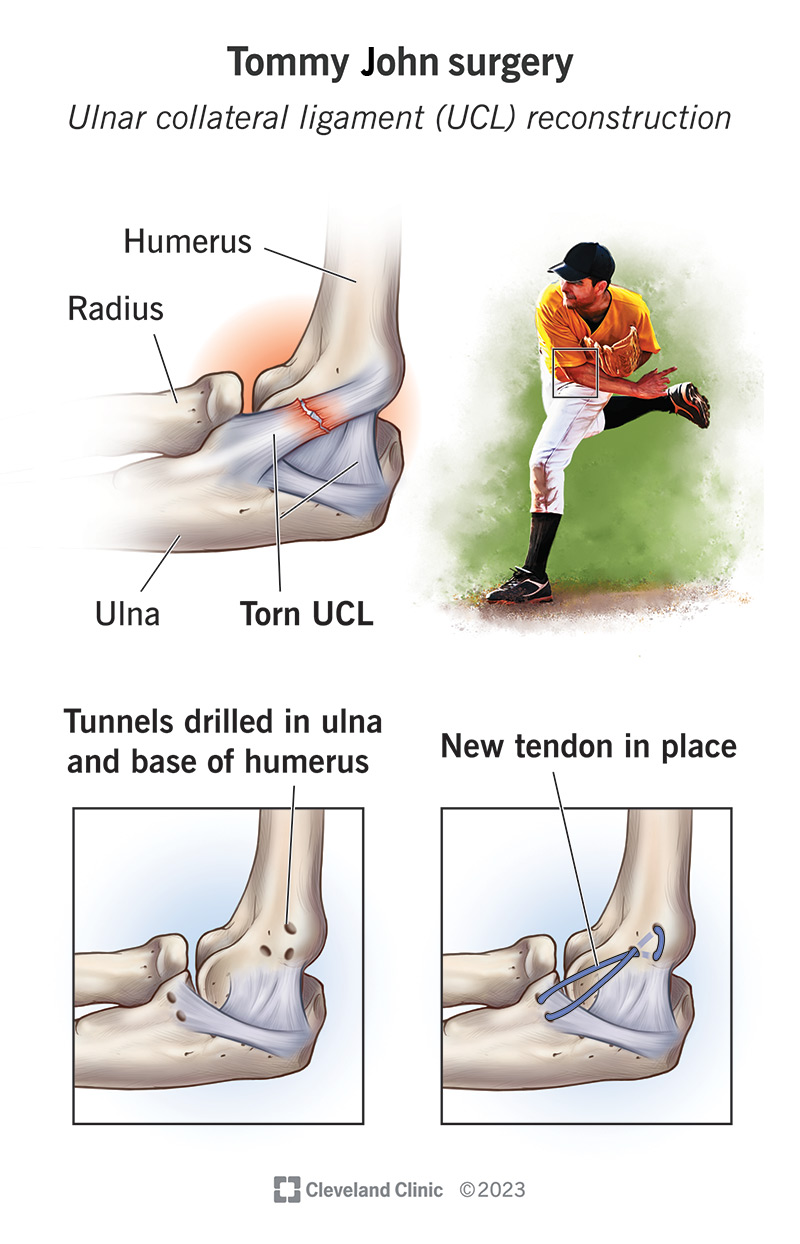 tommy-john-surgery-176.jpeg
