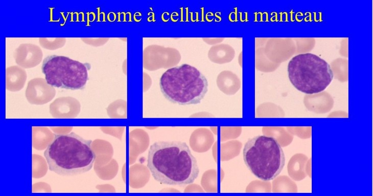 lymphome-du-manteau-0.jpeg