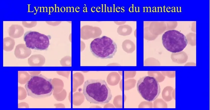 lymphome-du-manteau-0.jpeg