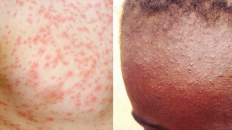 measles-34.jpeg