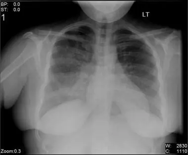 Understanding Pneumonia: A Respiratory Health Concern