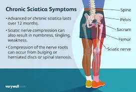Everything You Need to Know About Sciatica image 1