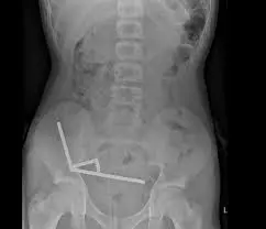 swallowing-magnets-5.jpeg