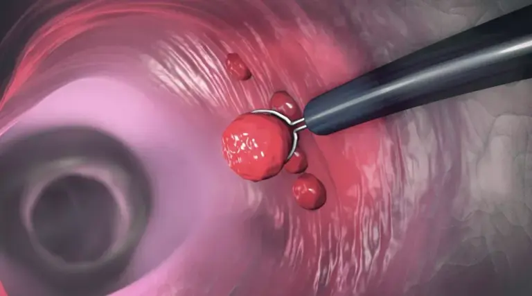 colorectal cancer — CA news